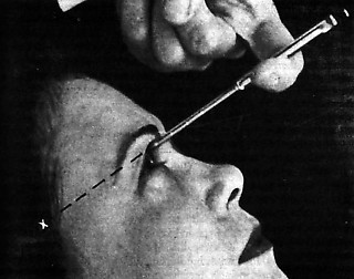 1──「アイスピック」を使った 経眼窩的ロボトミーの手法